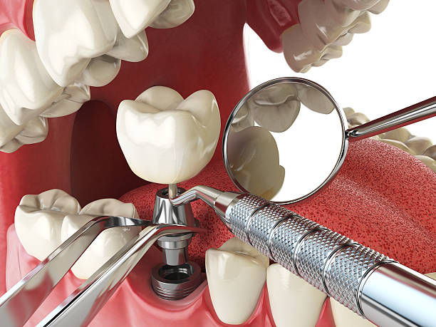 Best Broken or Chipped Tooth Repair in Pipestone, MN